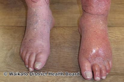 cellulitis-example