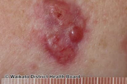 pinnacleskin.com /conditions/basal-cell-carcinoma Carousel 1 Image 5