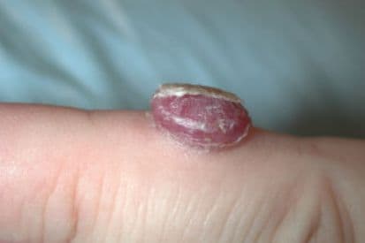 pinnacleskin.com /conditions/granuloma Carousel 1 Image 3