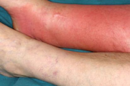 cellulitis-2