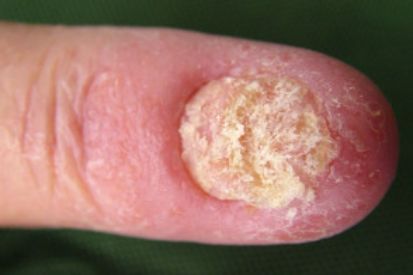 Cutaneous-Candidiasis-1