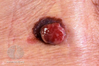 melanoma3