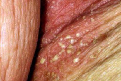 Cutaneous-Candidiasis-4