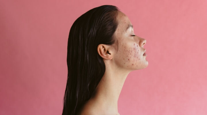 woman with acne on cheek