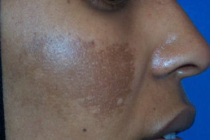 Melasma5