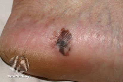 melanoma2