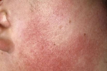 Keratosis-pilaris5